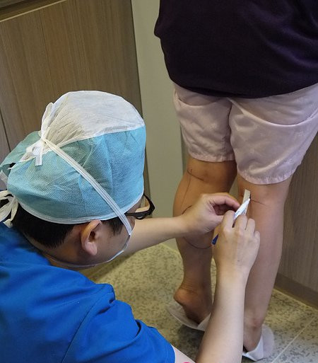 小腿神经阻断术前设计 小腿神经阻断术前设计