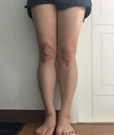 小腿神经阻断术