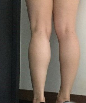 小腿神经阻断术